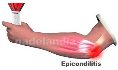 Epicondilitis codo