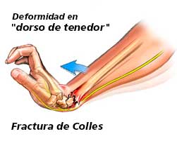 Fractura de colles